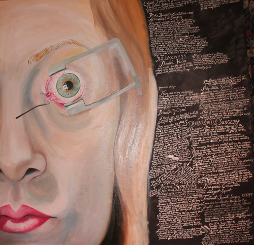 Strabismus Document (2012)